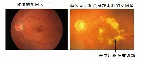 糖尿病引發的眼底病變